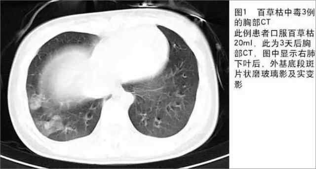 悲剧发生！花季少女喝下百草枯引发爆议！到底真相有多可怖？