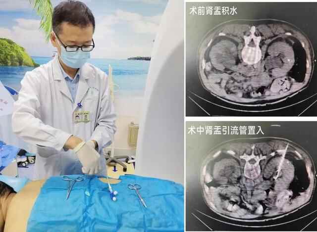 昌乐县人民医院：经皮肾盂穿刺造瘘术为输尿管梗阻患者解除痛苦
