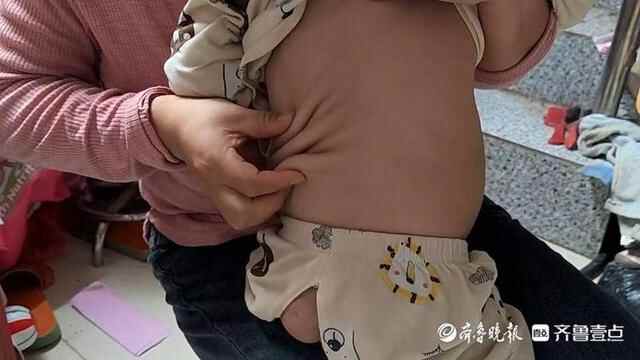 这是啥怪病？两岁娃皮肤松弛像老人，聊城幼儿家长向全国求医